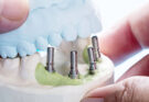 Same-Day Crowns: Streamlining Dental Procedures for Patient Benefits