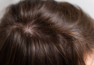 7 Everyday Behaviours That Make Dandruff Worse Without You Realising